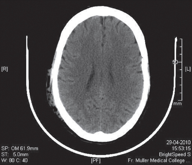 Unenhanced axial CT image shows a serpiginous subcutaneous mass in the right temporal-occipital region