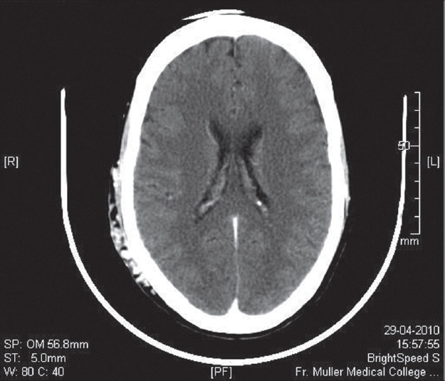 Contrast-enhanced axial CT image shows marked contrast enhancement within the cirsoid aneurysm