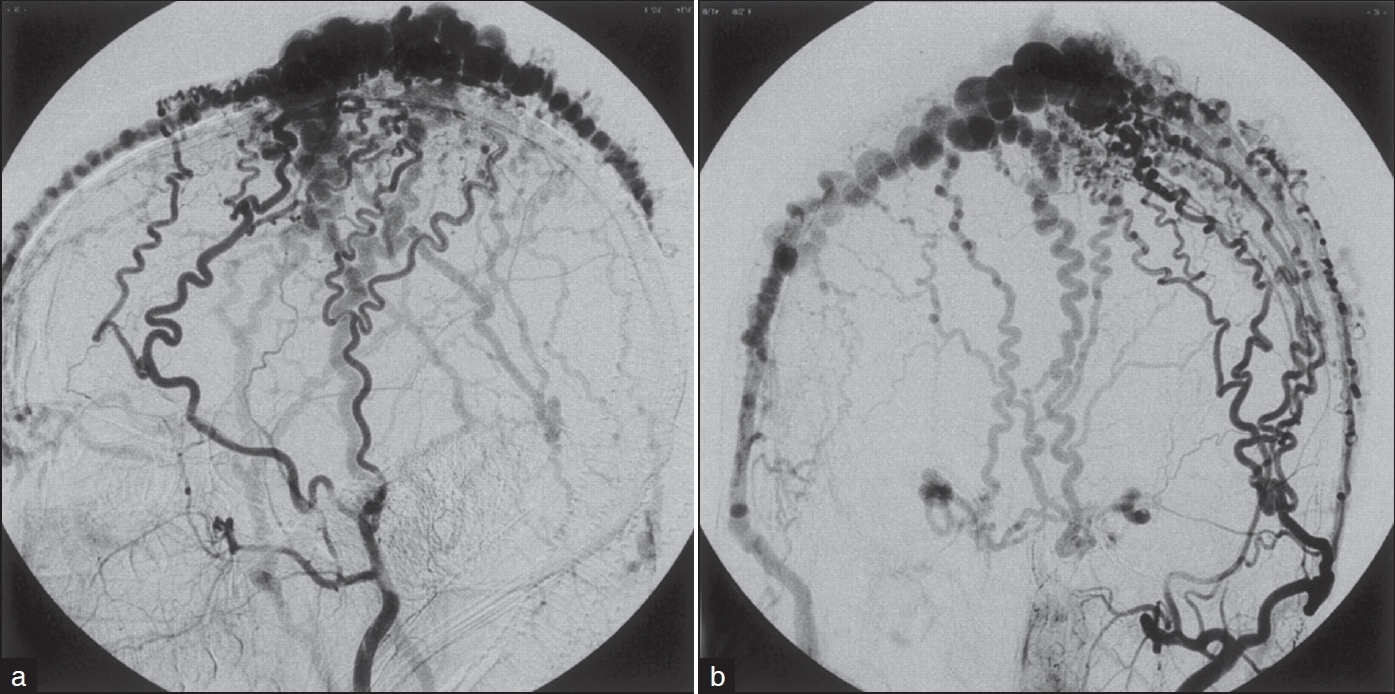 CT angiogram showing the lesion