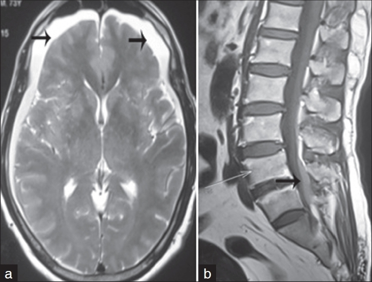 (a) Axial T2-weighted brain image shows subdural hemorrhage along bilateral frontotemporoparietal convexities (black arrow); (b) sagittal T1-weighted spine image shows subdural hemorrhage along the posterior thecal sac extending from L3 to S2 vertebra (black arrow)