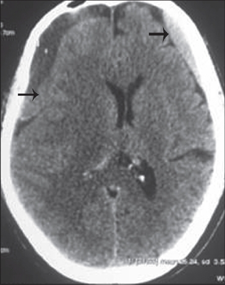 Axial CT brain shows bilateral large frontotemporoparietal subacute on chronic subdural hemorrhage about 2 cm in thickness on both sides, with significant midline shift (black arrow)