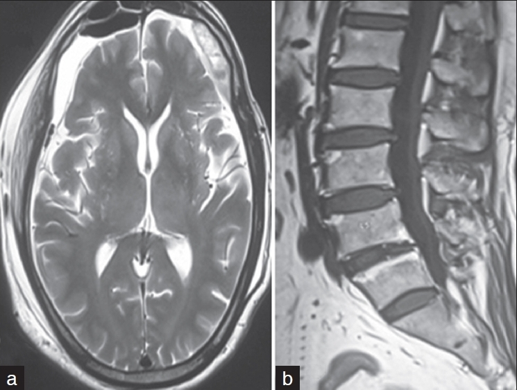 (a) Axial T2-weighted brain image shows significant resorption of hematoma with no midline shift; (b) sagittal T1-weighted spine image shows complete resorption of hematoma