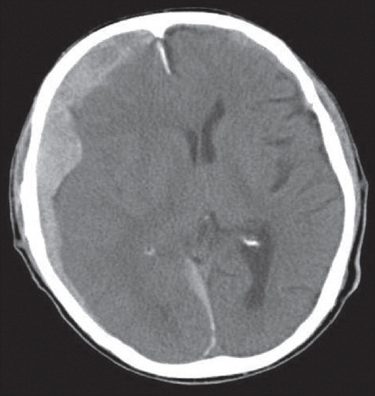 CT scanning showed both side of the ASDH in the supratentorium