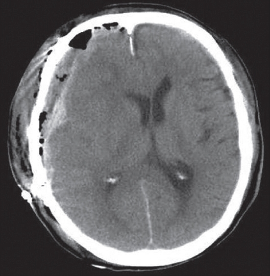 CT scanning after the second surgery showed the AEDH was removed