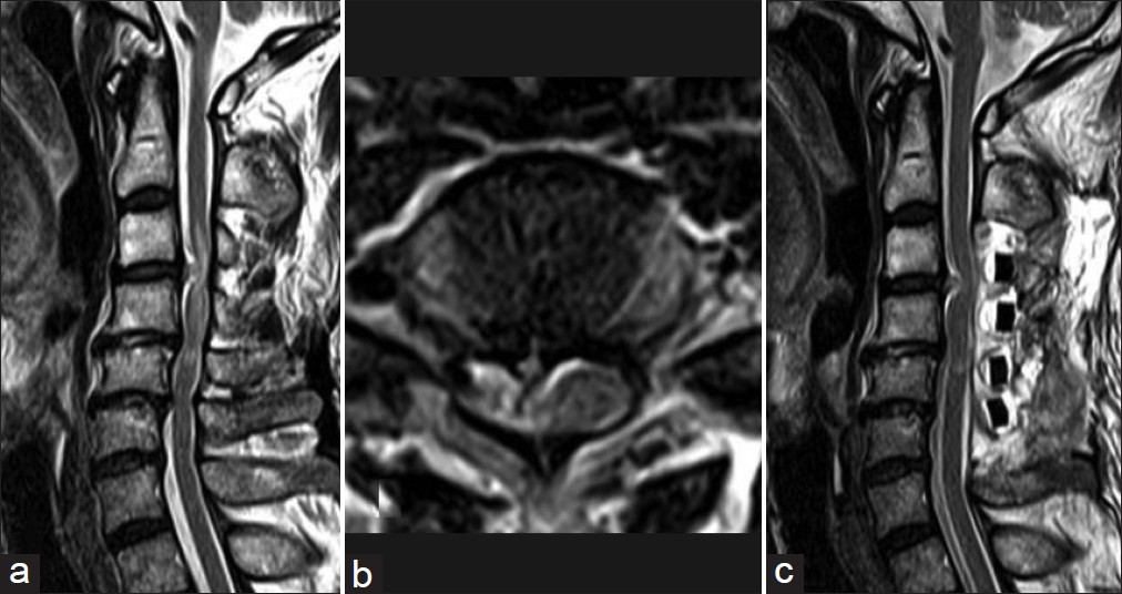 Pre and postoperative magnetic resonance images of the cervical spine. (a) Preoperative sagittal T2-weighted image showing a C3-C4 herniated disc, cervical cord signal change with edema, and C4 through C7cervical canal stenosis. (b) Preoperative axial T2- weighted image consistent with signal changes in the right hemicord. (c) Post-operative magnetic resonance image of the cervical spine. The sagittal T2-weighted image shows the improvement of signal changes in the hemicord