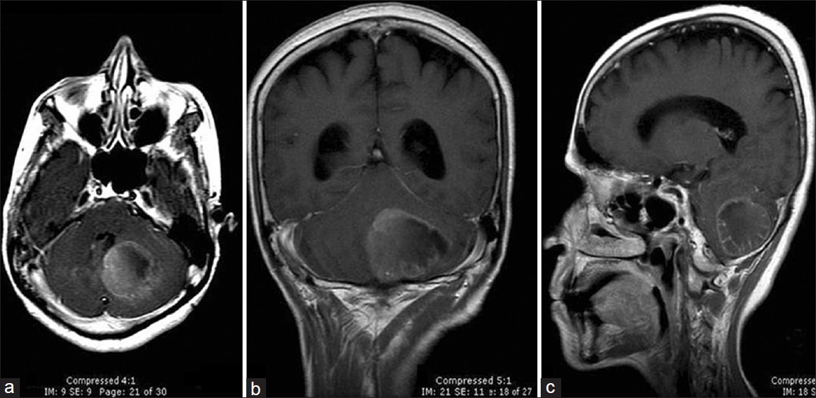 (a-c) Pre-operative MRI of the brain demonstrating the lesion. Axial (a), coronal (b) and sagittal (c) images of T1W post-contrast images revealed a heterogeneous enhancement in a well-circumscribed intra-axial lesion in the left cerebellar hemisphere measuring 3.2 × 3.8 × 4.3 cm. The lesion is seen abutting the left lateral recess of the fourth ventricle with mass effect