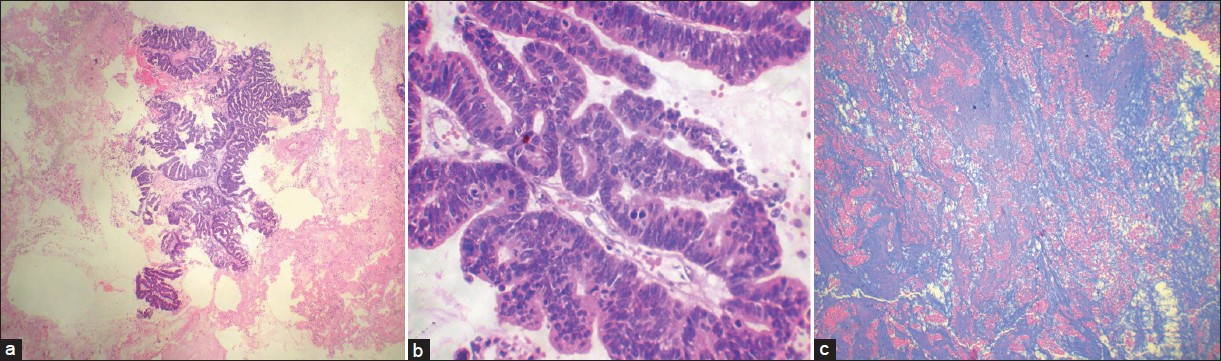 (a-c) Paraffin section showing a metastatic adenocarcinoma [hematoxylin and eosin (a) ×40; (b) ×100]. Abundant mucin secretion visualized [Alcian Blue stain ×100]