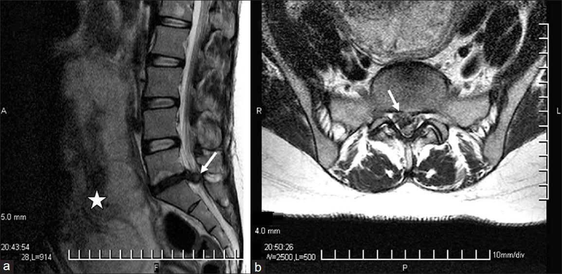 (a) Sagittal T2 weighted magnetic resonance imaging demonstrating a large sequestered disk fragment at L5-S1 level causing cauda equina compression (white arrow), the enlarged uterus with fetus (asterisk). (b) Axial T2 weighted MRI demonstrating a large sequestered central-right paracentral disk fragment at L5-S1 level (white arrow)