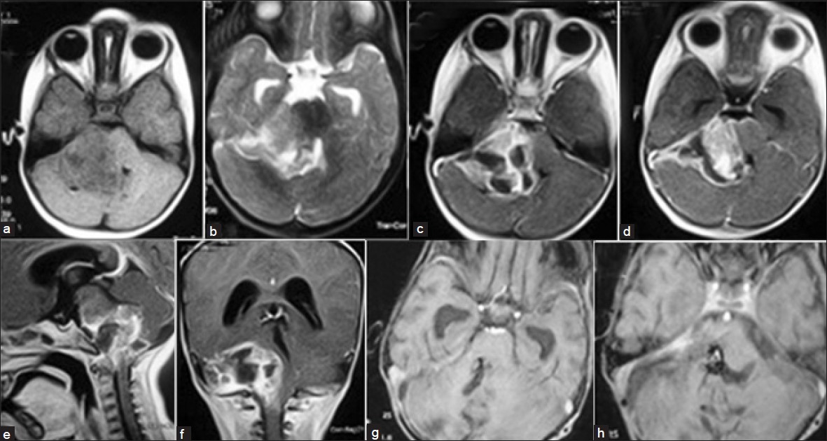 (a) Axial T1-weighted image showing iso-hypointense lesion in the right cerebellopontine (CP) angle. (b) Axial T2-weighted image showing the extra-axial hyperintense lesion in the CP angle. (c and d) Contrast axial image showing the enhancing lesion with cystic areas compressing the brain stem and fourth ventricle. (e) Sagittal contrast magnetic resonance imaging (MRI) section showing the extent of lesion. (f) Coronal contrast MRI section showing the extent of lesion. (g) Axial contrast MRI showing gross total excision and opened fourth ventricle. (h) Axial contrast MRI showing gross total excision and the foramen of Luschka is clear