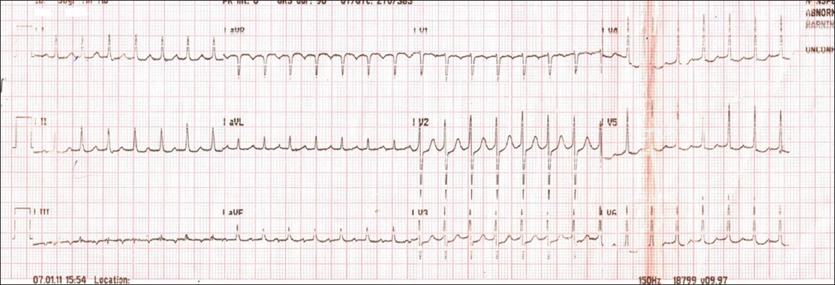 ECG showing regular narrow QRS complex long RP tachycardia (186 bpm)