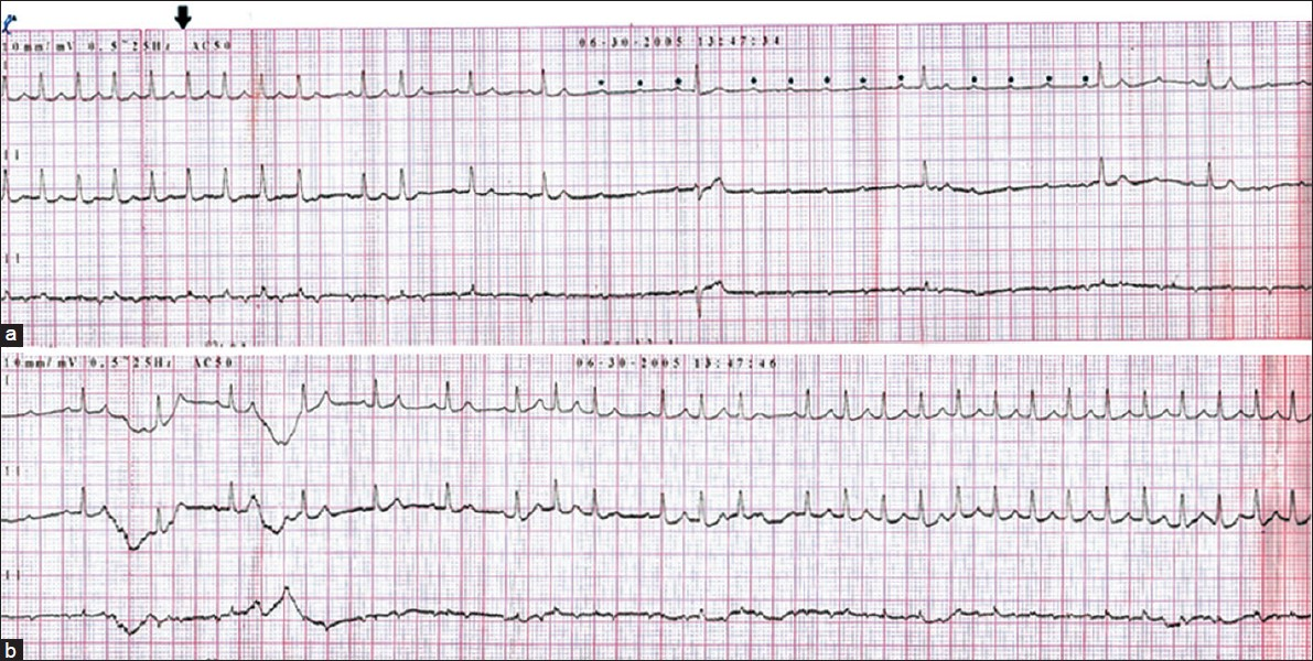 ECG (a) showing A-V block with atrial rate of 186 bpm with regular p waves (asterisk) following adenosine (arrow) and (b) showing reversion of rhythm to AT after 1 min following adenosine