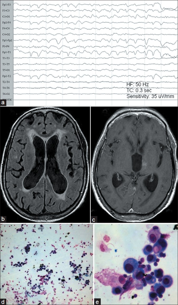 (a–c) Scalp EEG showing periodic biphasic and triphasic broad complex sharp waves occurring at 0.5–1.5 Hz frequency in both fronto-temporal leads (left>right); (b and c) axial MRI of brain showing cortical atrophy and peri-ventricular changes (b: FLAIR) and right thalamic contrast enhancing lesion probably metatstatic in the T1W post-gadolinium sequence (c). (d and e) CSF cytology showed clusters of large cells with eccentric nuclei and abundant deeply basophilic cytoplasm. Some display intracytoplasmic coalescing vacuoles containing mucin (arrows). Enmeshed small mature lymphocytes and scattered macrophages are seen in the background. [Leishman stain ×300.]