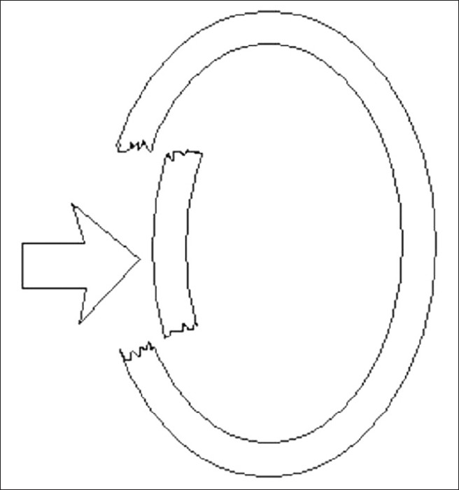 Diagrammatic representation of depressed skull fracture. The arrow represents the applied force causing the fracture with displacement of the floating segment inwards