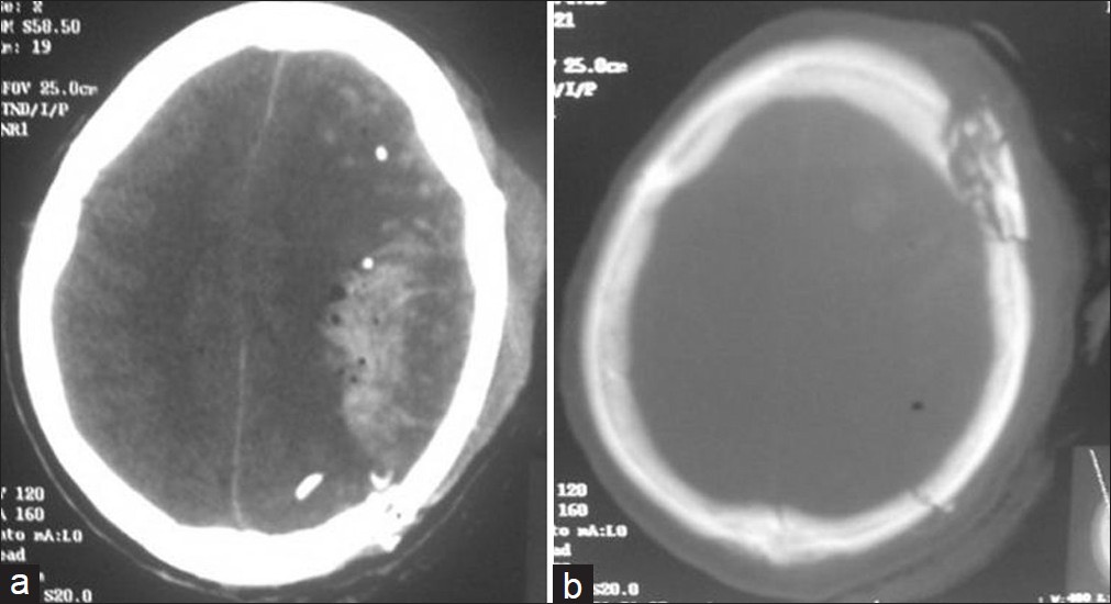 Cranial CT scan, brain and bone windows