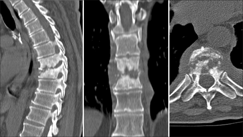 Sagittal, coronal, and transverse views of the CT scan show the extent of bone fragmentation and sclerosis