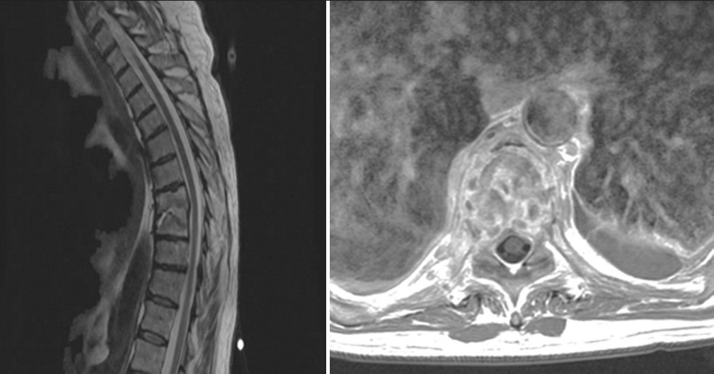 Magnetic resonance imaging of thoracic spine with contrast shows involvement of T8, T9 vertebral bodies with associated pre-vertebral soft tissue inflammation