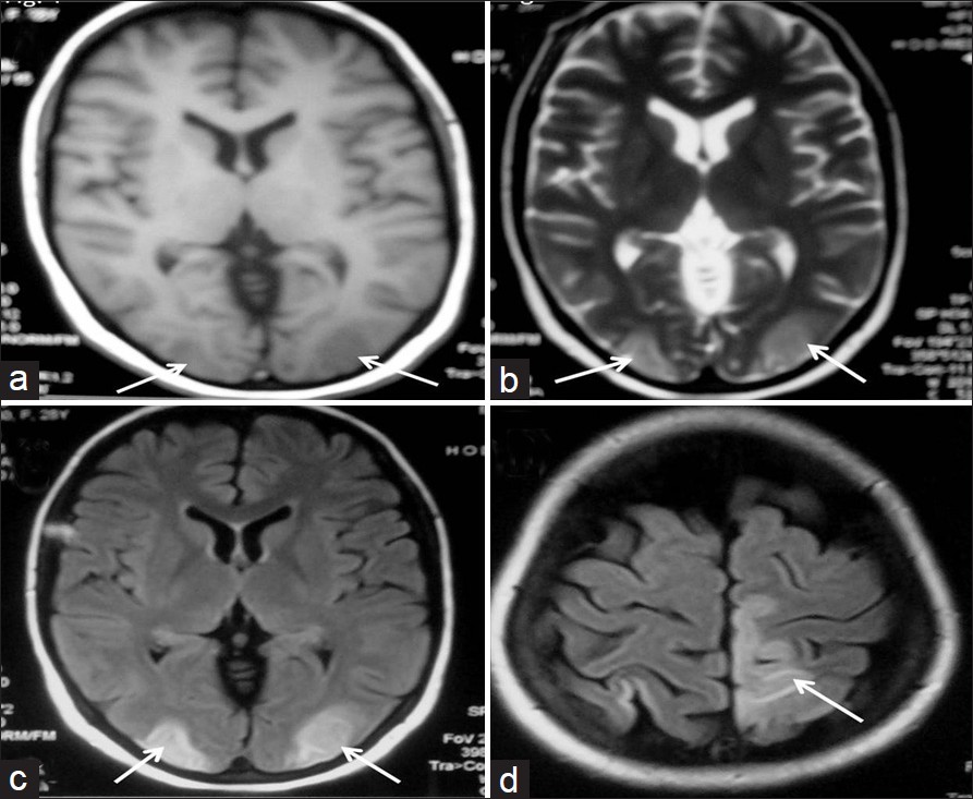 MR images showing hypointensities on TIW (a) and hyperintensities on T2W (b) in bilateral occipital lobes. FLAIR images (c, d) showing hyperintensities in the bilateral occipital lobes and left high parietal region with sparing of the calcarine and paramedian occipital lobe structures