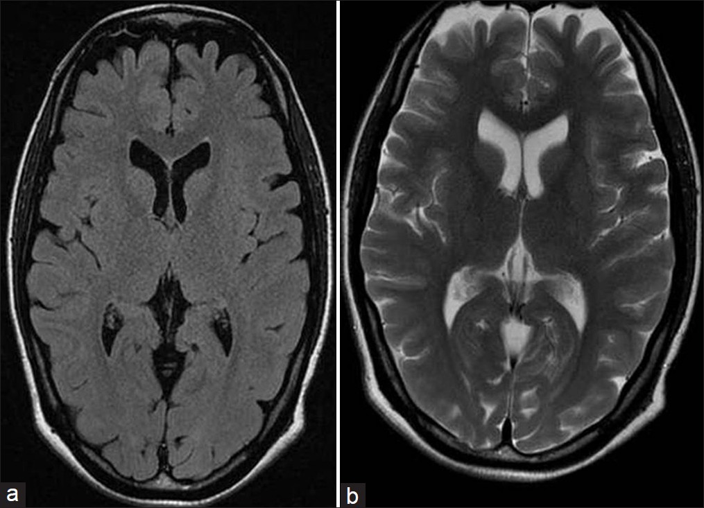 T1 (a) and T2 (b) weighted MR images showing resolution of lesions after six weeks of follow-up