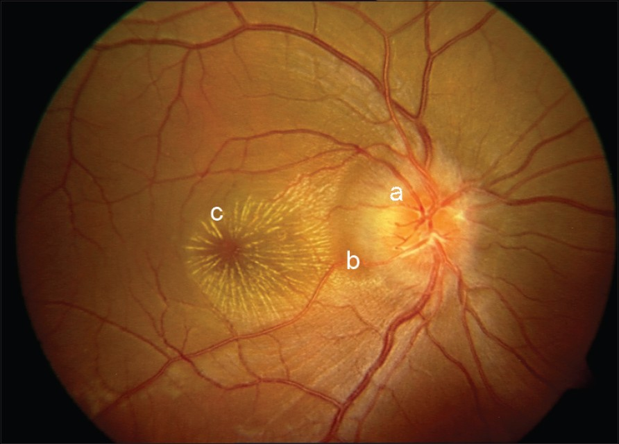 Neuroretinitis showing (a) swelling of disc with (b) retinal edema and (c) macular star