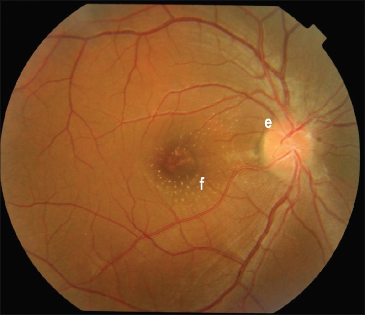 Partial resolution of (e) disc edema with (f) few hard exudates in macular area