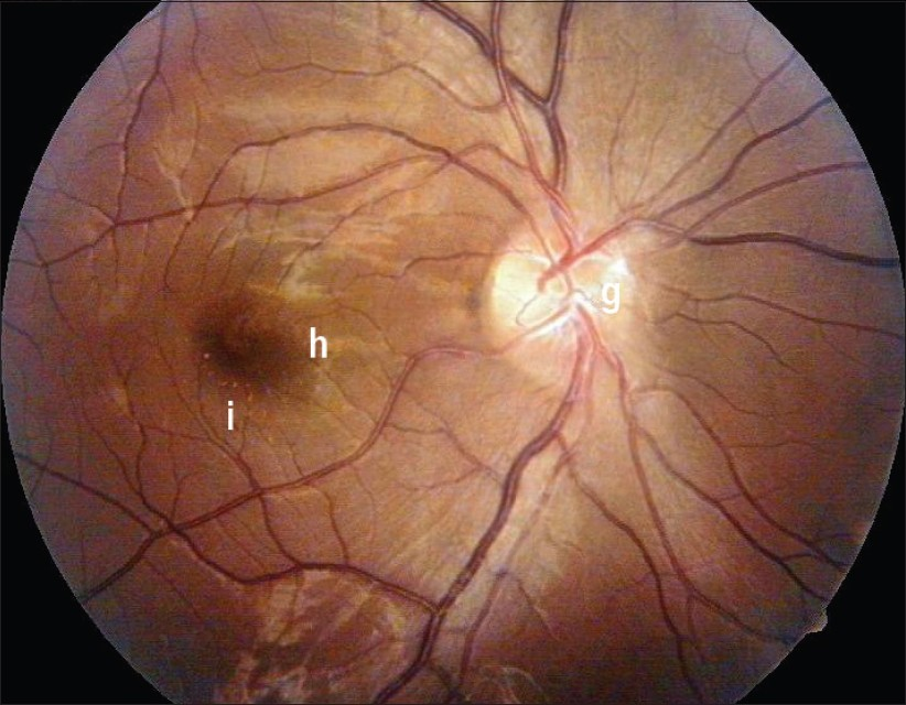 Fundus revealing (g) mild sheathing of vessels over the disc and (h) complete resolution of retinal and macular edema with few (i) retinal pigment epithelial changes