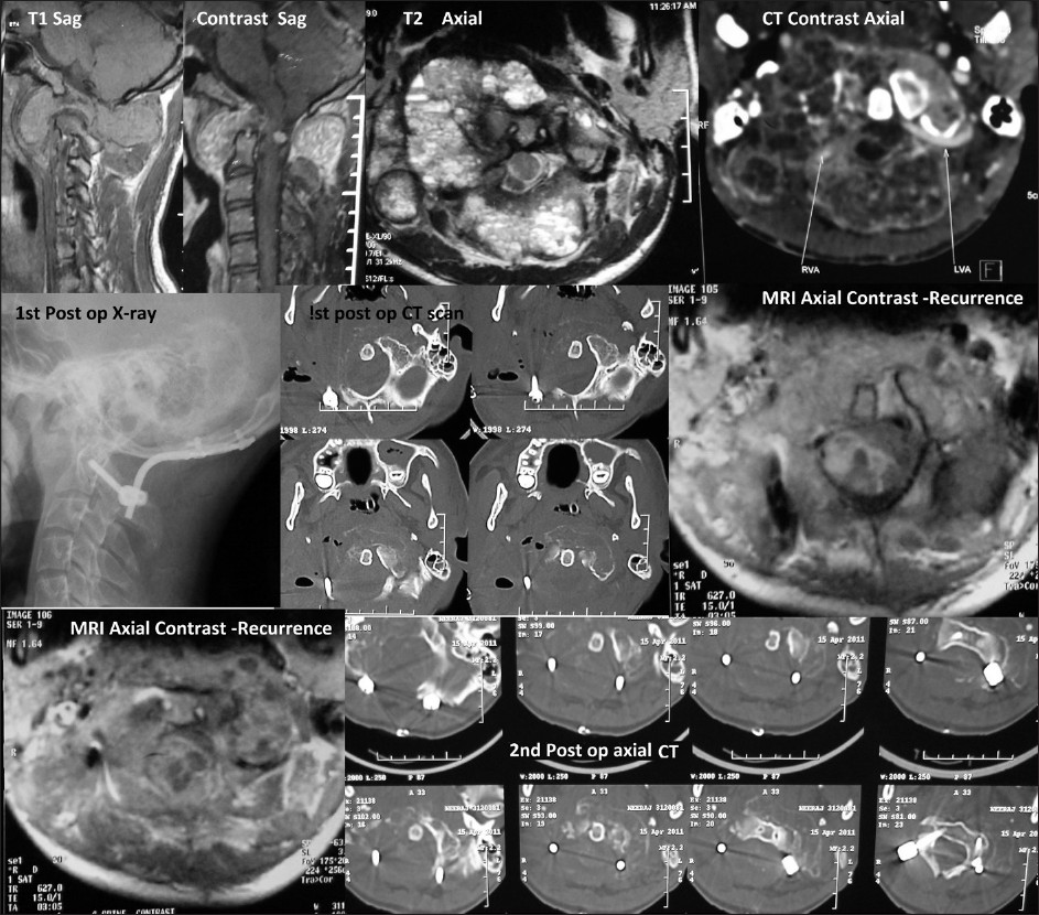 Upper row- Preop images showing hypo-iso intense lesion (T1) showing extension across the facets with contrast enhancement. T2 axial image showing multiple cysts involving the posterior arch of atlas and extending into the right lateral mass, anterior arch and occipital condyle. Adjacent to that is pre-op CT showing expansile bony lesion and engulfed vertebral arteries (arrows). 2nd row. Post op CT and X-ray shows excision of lesion (right side) with instrumentation. Adjacent to that is MRI (axial) showing recurrence posteriorly followed by second postop CT scans showing instrumentation.