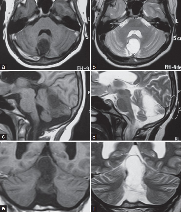 Axial (a and b), Saggital (c and d) and Coronal (e and f) non-contrast MRI images showing a vermian lesion which is hypointense on T1W (a, c and e) and hyperintense on T2W (b, d and f). Fourth ventricle is normal in shape. A faint outline of the occipital dermal sinus tract may be made out on saggital T2W image (d, circled area)