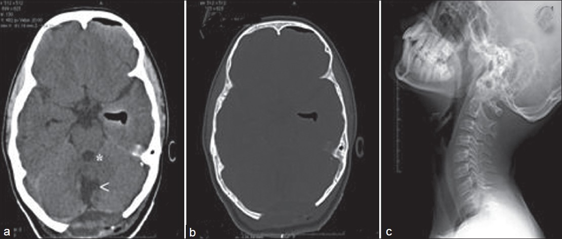 Post-operative CT showing resection cavity (white arrow) and fourth ventricle (*) (a) and bone windows showing craniectomy defect (b). X-ray cervical spine showing no Klippel-Fiel deformity (c)