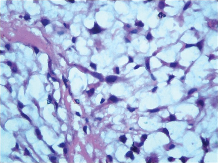 Large bubbly-looking tumor cells with stellate-shaped nucleus and abundant vacuolated cytoplasm (physaliphorous-like cells) [hematoxylin and eosin × 400]