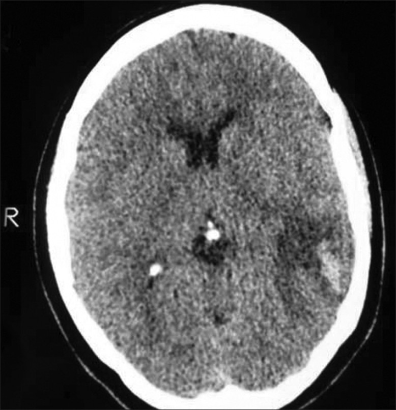 CT scan of the brain; hemorrhagic infarction and peripheral edema in the left posterior parietal and the temporal lobes