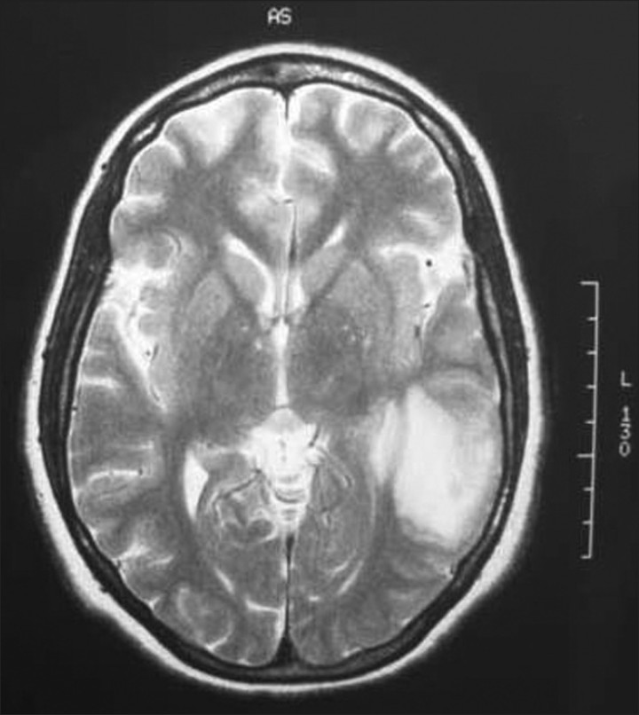 MRI of the brain; hemorrhagic infarction of the left temporal lobe