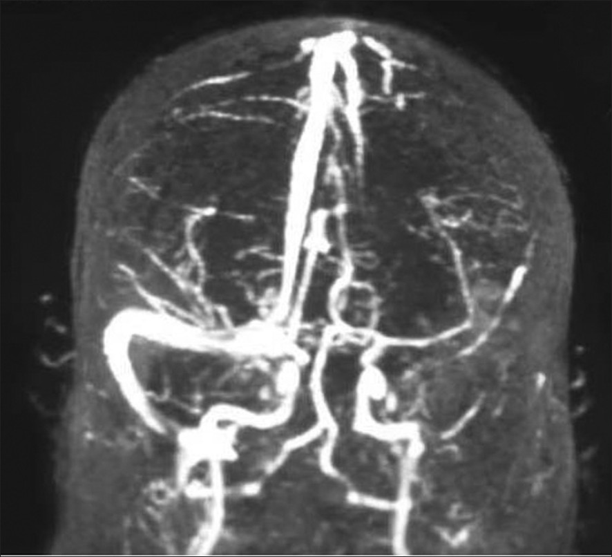 MRV of the brain; the left transverse sinus thrombosis