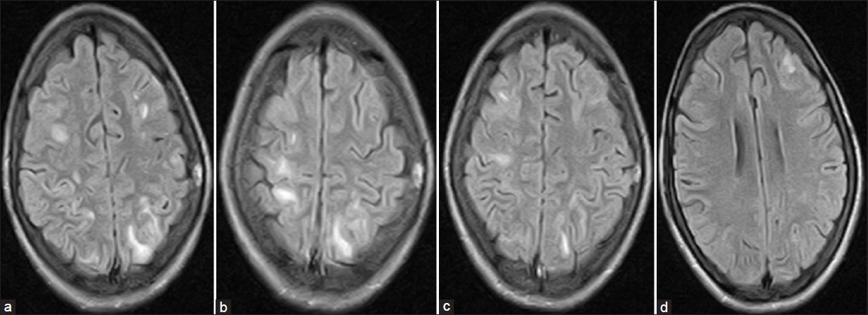 MRI brain (Flair) showing hyper intense patchy areas of demyelination at the time of second presentation