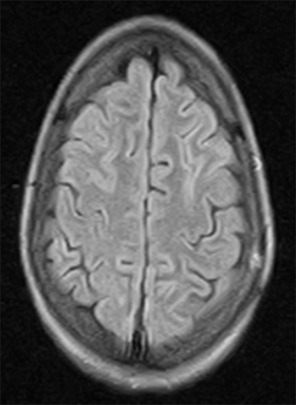 Repeat MRI brain after two weeks showing complete resolution