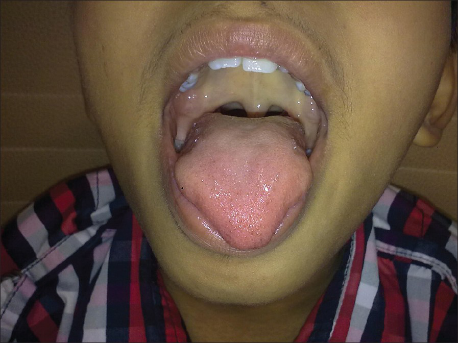 Improvement in tongue weakness and wasting noted at 6 months