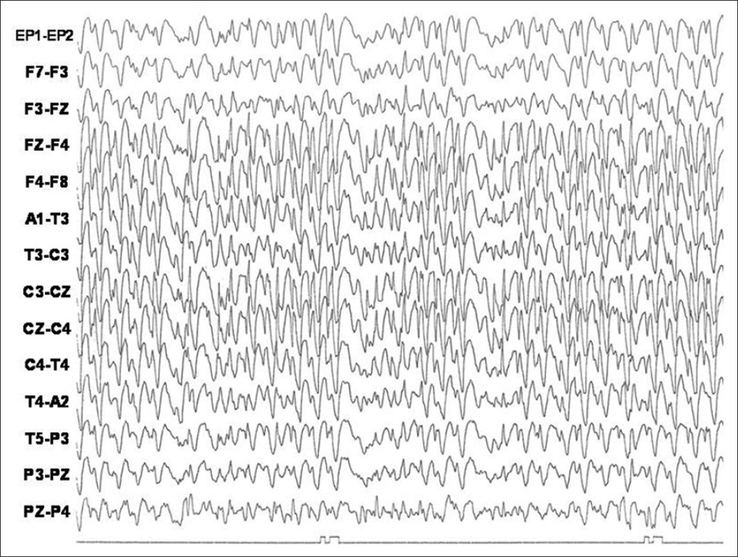 3-Hz diffuse spike-and-slow wave activity