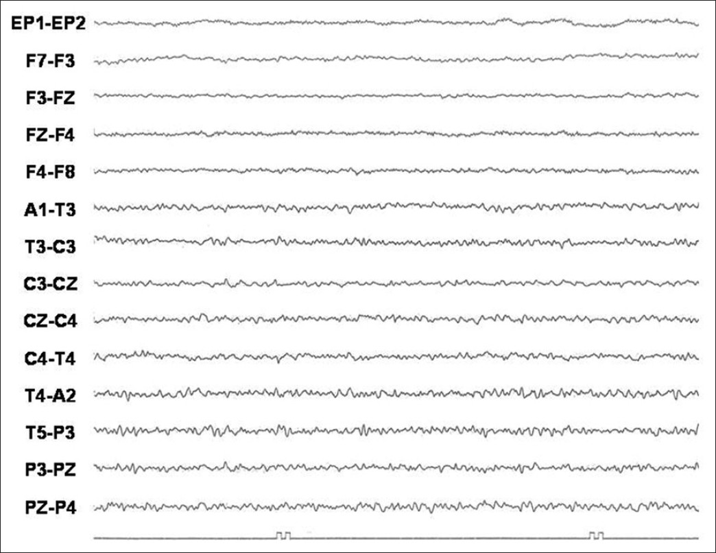 Normal EEG