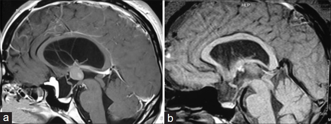 Sagittal sections of contrast-enhanced magnetic resonance images of brain showing cystic lesion in the suprasellar area with small solid part anteriorly. Cyst displaced the pituitary stalk posteriorly. Pituitary gland is seen compressed in the sella. Colloid cyst of the third ventricle is evident with mild ventriculomegaly (a). Post-operative scans (48 hrs) scans showed complete excision of dermoid and colloid cyst with decreased mass effect on the optic chiasm (b)