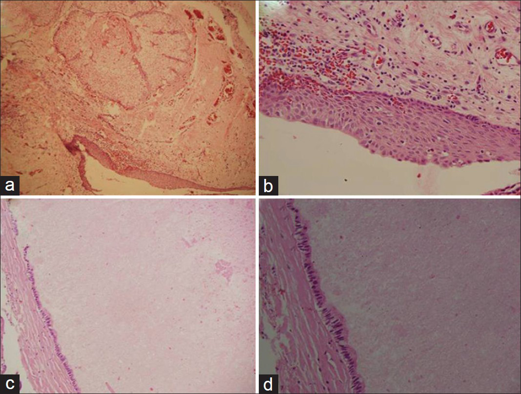 Photomicrographs showing stratified squamous epithelium with underlying sebaceous glands (a). Higher magnification of the lining epithelium (b). Colloid cyst wall comprising fibrocollagenous wall and is lined by columnar epithelium (c) with high-power view of lining epithelium (d). (a, b: HandE ×100; c, d: H and E ×200)