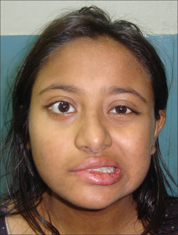 Right-sided LMN facial nerve palsy