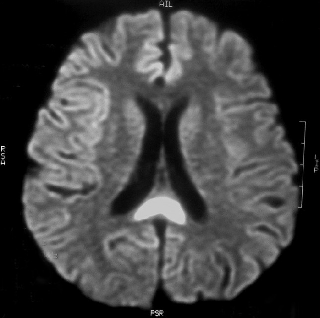 MRI of brain FLAIR sequence showing hyperintensity of splenium of corpus callosum (the Boomerang sign)