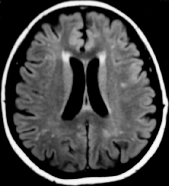 Repeat MRI of brain FLAIR sequence showing complete resolution of the hyperintensity of SCC