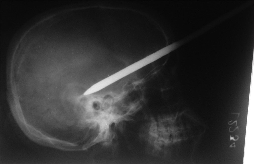 Skull lateral view X-ray showing the path of the rod