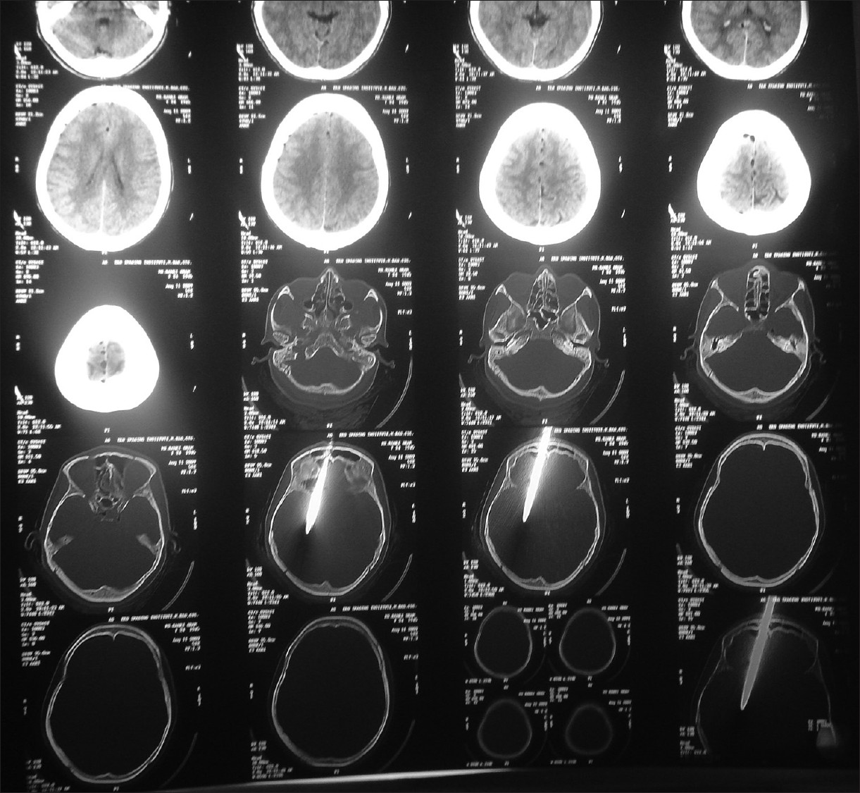 CT scan showing no parenchymal damage or extraaxial collection