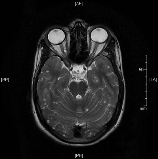 Magnetic resonance imaging brain with cystic lesion in right orbit compressing optic nerve and superior oblique muscle