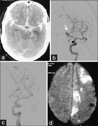 Thromboembolic complication of aneurysm coiling: A 54-year-old male with grade 1 SAH and ruptured Acom artery aneurysm; endovascular aneurysm coiling done with complete aneurysm exclusion from circulation with distal thromboemboli. (a) NCCT head at admission showing diffuse SAH. (b) Left ICA angiogram showing Acom aneurysm directed superiorly, and to right side (arrow). (c) Postcoiling left ICA angiogram showing well coiled aneurysm completely excluded from circulation. (d) Next morning DWI image showing restricted diffusion areas in left MCA and ACA territories