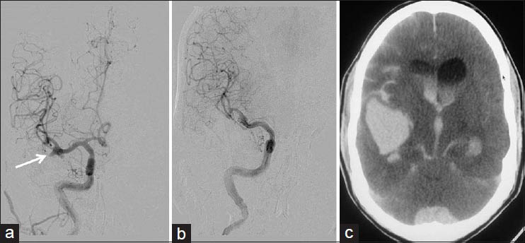 Rerupture of partially coiled aneurysm: A 46-year-old male with Grade 1 SAH and ruptured right MCA bifurcation aneurysm; after an hour of extubation after partial coiling, patient developed left hemiparesis followed by pupillary dilatation. (a) Right ICA injection frontal view showing MCA bifurcation aneurysm with broad base (arrow). (b) Postcoiling right ICA injection frontal view showing secured dome of the aneurysm with the patent lower part (c) CT done after patient developed hemiparesis, showing increased SAH with hydrocephalus, and large right Sylvian/temporal hematoma