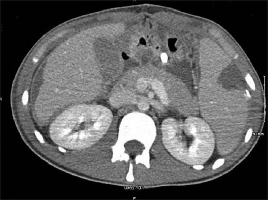 Horizontal section of CT abdomen showing splenic infarct