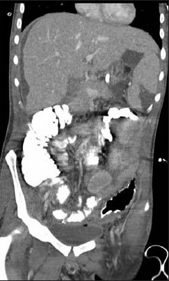 Coronal section of CT abdomen showing splenic infarct