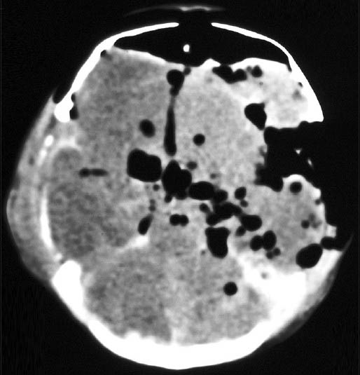 Computed tomography scan of brain: Tension pneumocephalus showing huge amount of air compressing the frontal lobes, with the “air bubble sign”